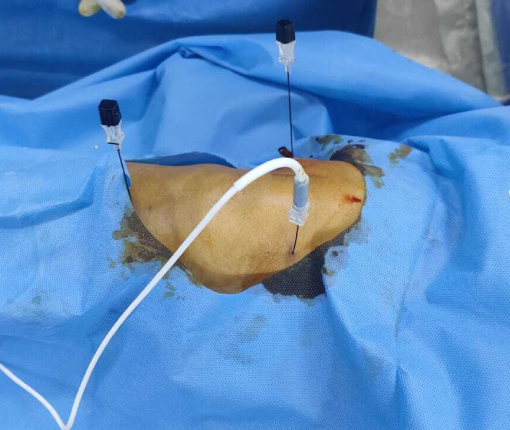 Dr.Milon.V.Mitragotri, 12 years in managing chronic, long lasting pain relief conditions,cancer, joint & nerve related